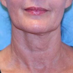 Sofwave Before & After Patient #1605